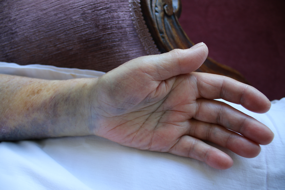 En blå och svullen hand vilar på ett tygunderlag. Foto.